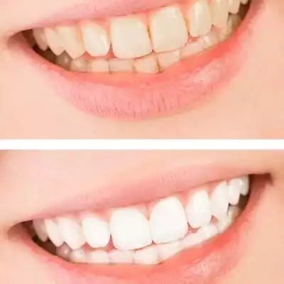 teeth whitening teeth whitening