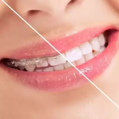 Before and after braces Before and after braces